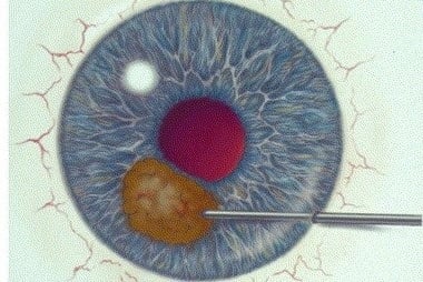 Рисунок 2. Тонкоигольная биопсия проводится ТОЛЬКО под операционным микроскопом. Хирург тончайшей иглой забирает немного клеток тканей с пораженного участка глазного яблока
