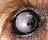 Ленс индуцированный увеит,синехии у собаки при перезрелой катаракте