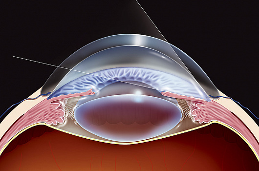 Медикаментозное, лазерное и хирургическое лечение глаукомы