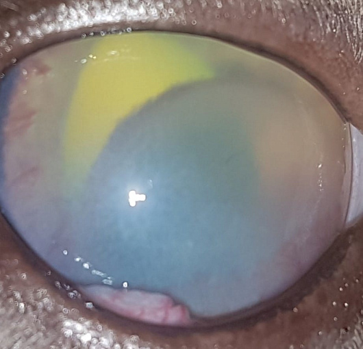 Люксация хрусталика в ПКГ, увеит, вторичная глаукома. Lens luxation in PCG, uveitis, secondary glaucoma