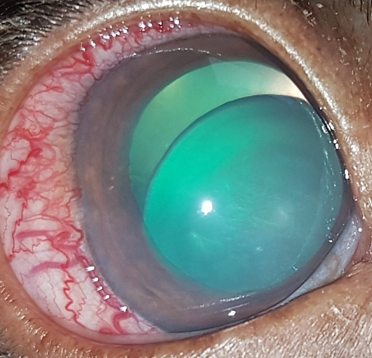 Люксация хрусталика в заднюю камеру глаза, вторичная глаукома у собаки. Lens luxation in the posterior chamber of the eye, secondary glaucoma in a dog